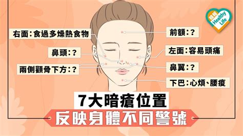 人中生瘡|【暗瘡位置】不同代表什麼？中醫教如何處理及預防